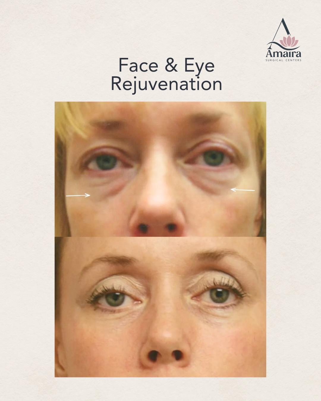 A refreshed look that still feels completely like you. ✨
Face & eye rejuvenation is all about restoring a more rested, refreshed appearance while maintaining the features that make you you.
Subtle changes. Thoughtful technique. Results designed to look naturally refreshed, not overdone.
🥼: Dr. Scott Wells
📍 Fort Lauderdale, FL | (954) 466-0202 @amairafortlauderdale
📍 Delray Beach, FL | (561) 210-1989 @amairadelray
📍 West Palm Beach, FL | (561) 621-1820 @amairawestpalm
#eyerejuvenation #blehpharoplasty #beforeandafter #results