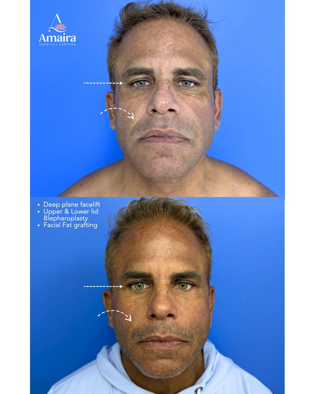 When laxity returns after a previous facelift, the approach matters.
This male patient came to Dr. Tarik Husain after undergoing a facelift with another surgeon and experiencing recurrent laxity through the neck and lower face.
For his secondary facial rejuvenation, Dr. Husain performed a Deep Plane Facelift, Upper & Lower Blepharoplasty + Facial Fat Grafting, addressing the deeper facial structures while restoring volume and refreshing the eye area.
The goal wasn’t to change his face. It was to restore stronger definition through the jawline and neck while keeping his results natural and masculine.
📍 Fort Lauderdale, FL | (954) 466-0202 @amairafortlauderdale
📍 Delray Beach, FL | (561) 210-1989 @amairadelray
📍 West Palm Beach, FL | (561) 621-1820 @amairawestpalm
#DeepPlaneFacelift #SecondaryFacelift #RevisionFacelift #MaleFacelift #NeckLaxity Blepharoplasty FacialFatGrafting