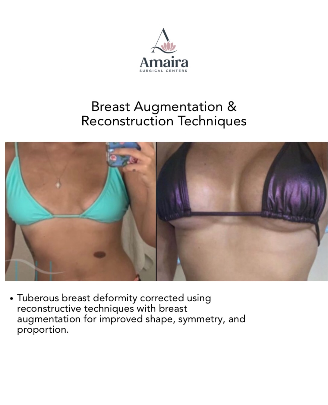 Not every breast augmentation is simply about adding volume. ✨
This patient presented with a tuberous breast deformity, which required a more reconstructive approach. Using breast augmentation combined with reconstructive techniques, the goal was to improve breast shape, symmetry, and overall proportion while creating a natural-looking result.
Every anatomy is different and the surgical plan should be too.
📍 Fort Lauderdale, FL | (954) 466-0202 @amairafortlauderdale
📍 Delray Beach, FL | (561) 210-1989 @amairadelray
📍 West Palm Beach, FL | (561) 621-1820 @amairawestpalm
#surgical #aesthetics #southflorida